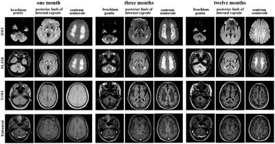 Case Report: Rapid Progression of Cognitive Dysfunction as an Initial Feature of Systemic Lupus Erythematosus With Leukoencephalopathy: A Case Report and Literature Review